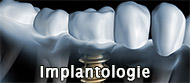 zahnarzthannover-anderten-implantologie